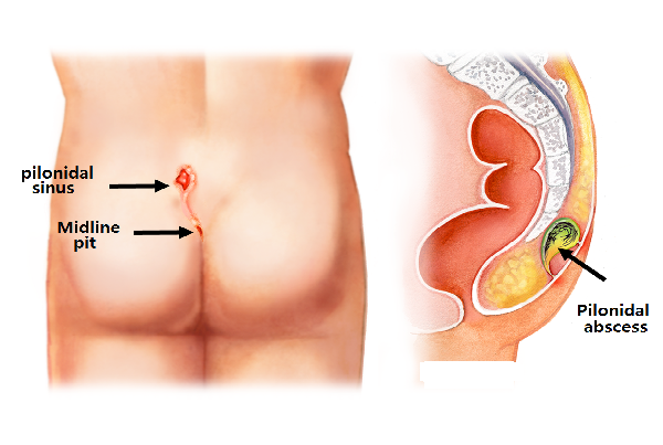Pilonidal Surgery
