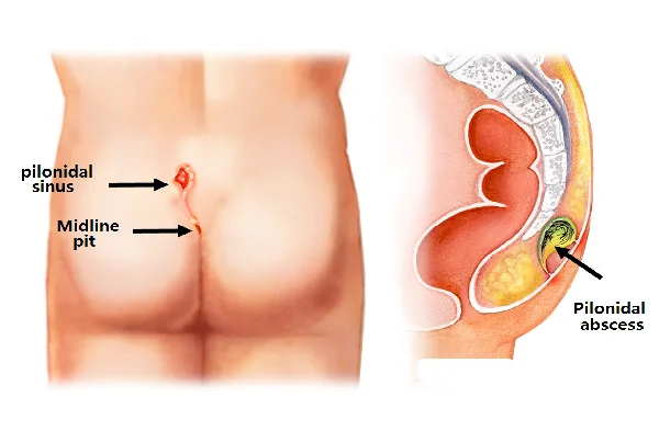Pilonidal Surgery